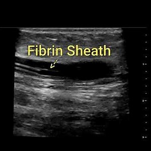 Blood Product Adhesion to Catheter