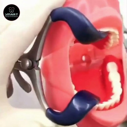 Mouth Gag Retractor | Better Visibility & Hands-Free Access During