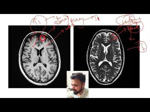 T1 vs T2 sequences(how to differentiate between T1 and T2 sequences)