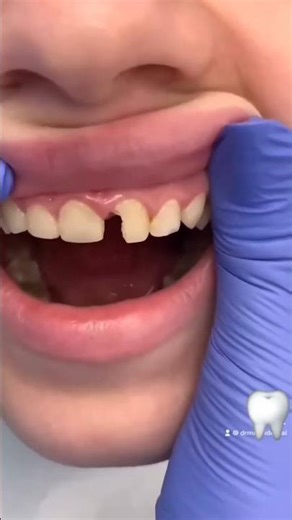 Broken Baby Tooth #dentist