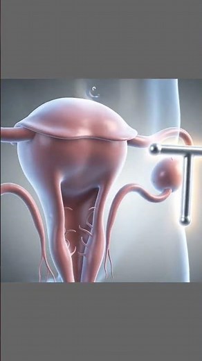 How IUD Birth Control Works? 💡 | 3D Medical Animation #3danimation #surgery
