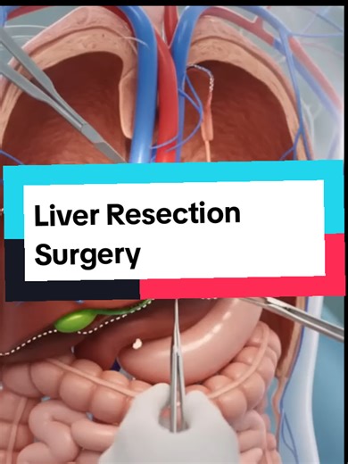 Liver_Resection_Surgery__How_the_Liver_Heals_and_Regrows_After_Cancer_Removal #liver #resection #surgery #medicalstudent #medical