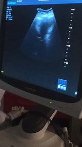 Biopsie transpariétale (BTP ) échoguidée d'une masse pulmonaire ✅ . . . . . . #hope #pneumologia #pneumo #medical #medicalstudent #radio #scanner #echographie #biopsie | Dr hope