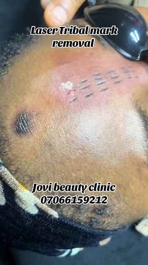 Tribal mark removal.