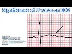 Significance of U wave on ECG
