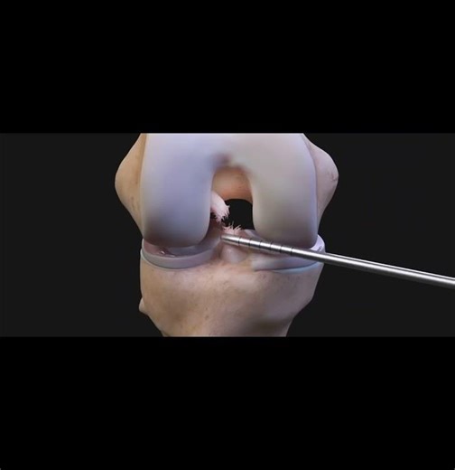 ACL Surgery Reconstruction Animation # ACL Reconstruction Surgery