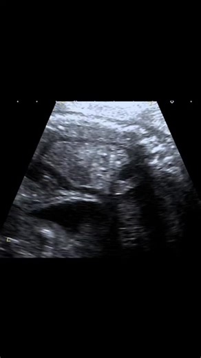 Radiology @all abnormalities 🥏🥏 on Instagram: "Detailed Obstetric Ultrasound with Fetal Doppler comp Presentation: Routine 20–24 weeks detailed obstetric ultrasound, primigravida (first pregnancy) Patient Data: Age: 35 years Gender: Female Technique: Detailed obstetric ultrasound with targeted fetal cardiac assessment and Doppler evaluation was performed. Findings Fetal Venous System Ductus venosus is absent. Umbilical vein is seen draining directly into the right atrium, consistent with abnor
