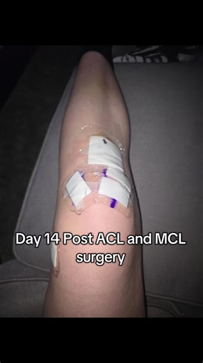 First Steps After ACL and MCL Surgery: Day 14 Progress