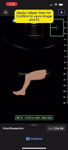 How to use biometry tool with Butterfly iQ