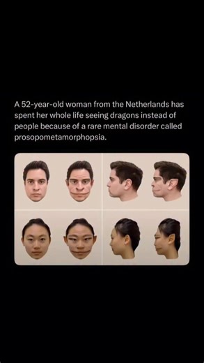 accepting follows now‼️ on Instagram: "Follow @hauntings for more 😱 A 52-year-old woman in the Netherlands has lived her entire life perceiving dragons where human faces should be — an exceptionally rare and severe form of prosopometamorphopsia, a neurological condition that alters how the brain interprets facial features. To her, eyes morph into reptilian slits, mouths become fanged snouts, and skin takes on a scaled appearance. Everything else in her environment looks normal, which only heigh