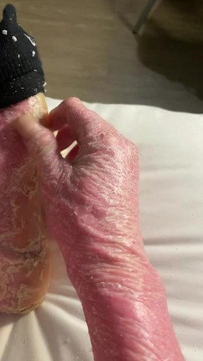 Caring for Foot Health: Skin Peeling Explained