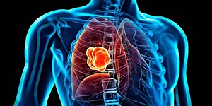 Los medicamentos de inmunoterapia aumentan las opciones para el tratamiento del cáncer de pulmón avanzado