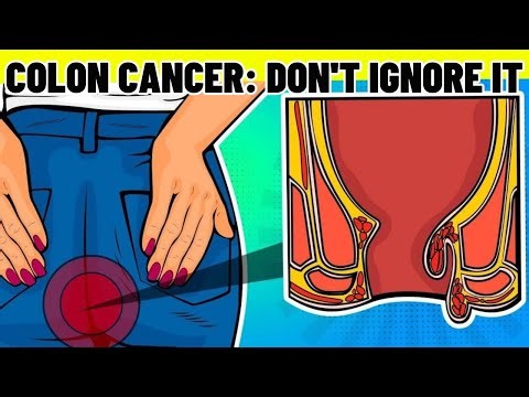 Early signs of colon cancer that you should not ignore!