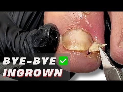 Watch This Toe Transformation – Painful Ingrown Toenail Gone!