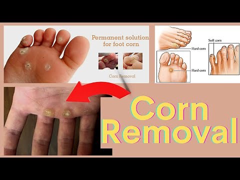 Corn Removal Treatment on the Hand & foot | Corn Removal by Laser