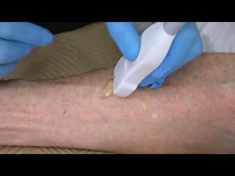 Prevue™ II Vascular Access System Traditional and Vascular Access Probes