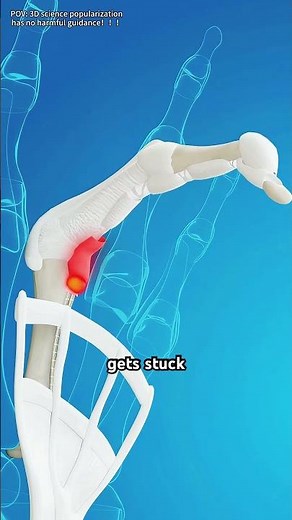 Trigger Finger Release Surgery & Fix (3D Animation) #triggerfinger#3danimation#triggerfinger