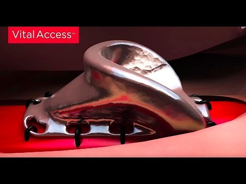 VWING Guided Cannulation Technique