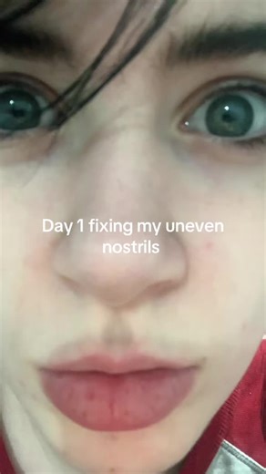 Improving My Appearance: Day 1 Lip and Nostrils