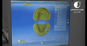 Full digital workflow for single tooth replacement with JD implant.- by dr. Maxim Baini – Lebanon. Don't miss the session of Dr. Maxim Baini during next JDSymposium 2018, Riva del Garda www.jdentalcare.com #jdentalcare #jJDmplants #implantdentistry #immediateloading #foreverJD #JDEvolution #Allon4 #allon6‬ #flapless #JDfamily #Madeinitaly #JDImplants #JD4 #JDDigital #JDSymposium2018 | JDentalCare