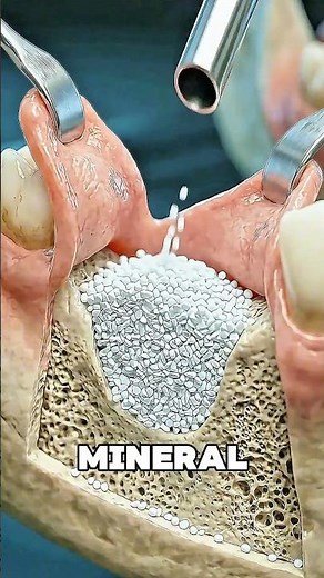 How Dentists Rebuild Your Jawbone 🦷🤯