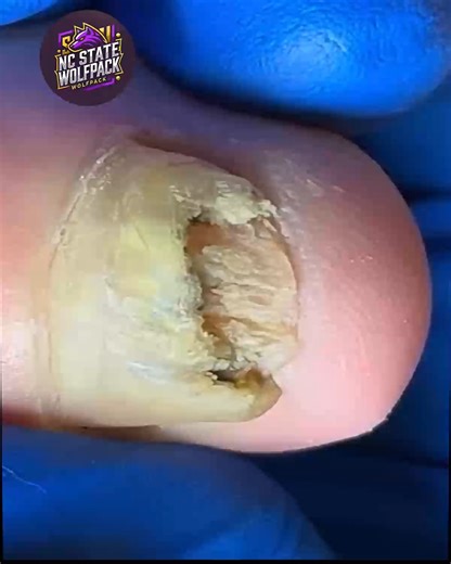 9.5K views · 88 reactions | Simple Steps to Support Damaged Nail Surfaces That Keep Your Nails Strong #CleanNailsDaily #HealthyNails #NailCareTips #ToenailRoutine | NC State Wolfpack on TheWolfpacker.com | Facebook