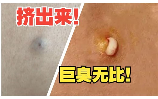 #皮脂腺囊肿 挤出来超级臭！粉瘤应该怎么处理？#健康科普 #医学科普 #希望能帮到有需要的人