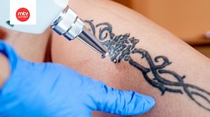 Tatuoinnin poisto sattuu enemmän kuin kuvan ottaminen – tietyt kohdat ovat riskialttiimpia arpeutumiselle