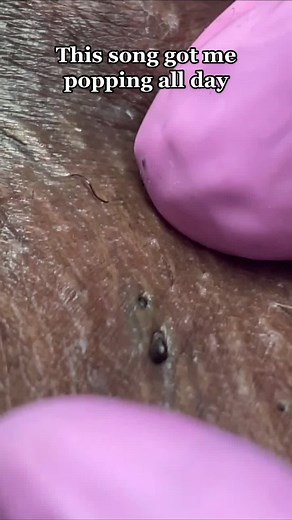I love this mix 🥹 #galaxyextraction #extractionsatisfaciton #pimplepopper #ingrownhairremoval #music