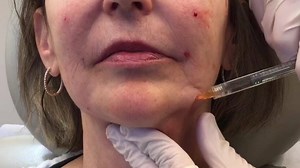 Volumizing the lower third of the face is critical in treating the aging face. Some individuals inherently have a "weaker" chin and mandible and fillers can create the balance they never had. Furthermore, volume in this area is lost with age and can be easily restored. Watch how easy this is with Matt Kelleher, MD’s cannula technique and particularly pay attention to how the marionette lines "pop" out. Happy #SkinCareSaturday! #filler #wrinkles | Premier Dermatology | Facebook
