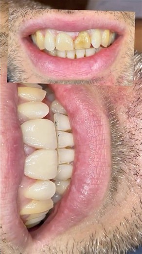 Composite Veneers Step by Step Under the Microscope