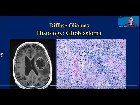 Understanding Neuropathology: UCLA Brain Tumor Virtual Conference