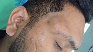 Giant Angular Dermoid | Dr Khaled's Tumour Helpline