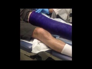 Video#862 Full Leg Cast Removal