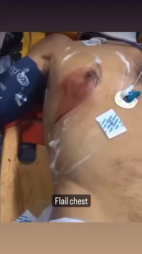 MedWorld- Medical & Health on Instagram: "Great example of flail chest and paradoxical movement! 🫁 Flail chest is when a portion of the rib cage is separated from the rest of the chest wall, usually due to a severe blunt trauma. This affected portion is unable to contribute to expansion of the lungs, which creates major problems for the patient. Injuries like this will cause the ribs and chest wall to malfunction in the ways they move. The movement, called paradoxical, means the injured section