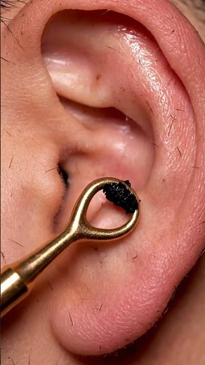 Favorite Watch This Satisfying Pimple ear Removal!