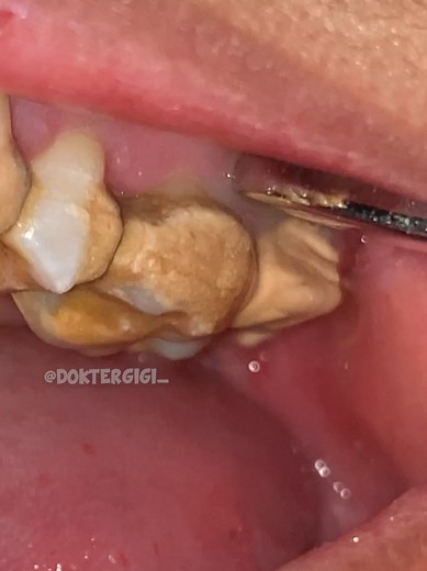 Scaling Gigi Profesional oleh Dokter Gigi Tri Putra