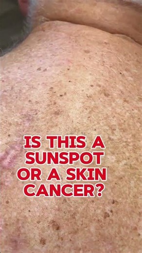 Skin cancer or sun spot? Imagine if this was your back? How could anyone tell if any of these spots
