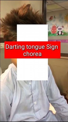 Chorea signs- Darting tongue sign- Athetosis, hemiballismus, tremors-Treatment , investigations