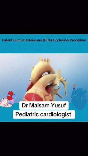 PDA occlusion procedure dr Maisam