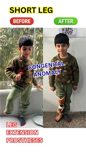 😱 Leg Extension Prosthesis for Short Leg | Congenital Anomaly Fix