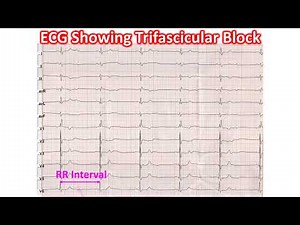 ECG Showing Trifascicular Block