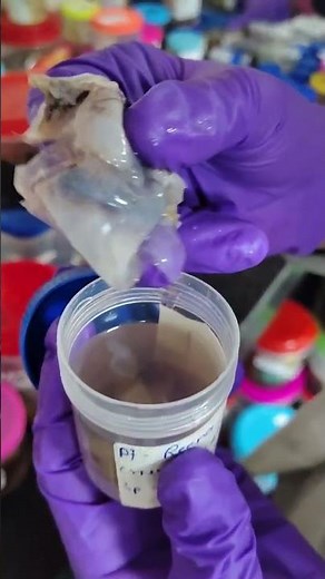 RT Fahlopian tube RT tube rightFallopian tube