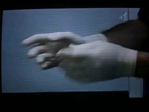 Suction termination treatment abortion