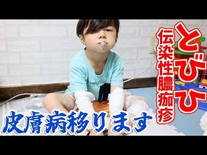 【閲覧注意】皮膚病とびひになりました。