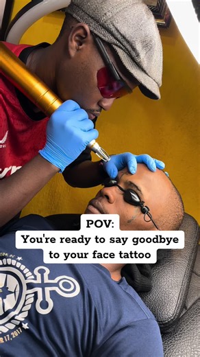 Face Tattoo Removal: Your Guide to Laser Techniques