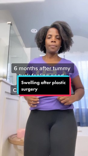 Dealing with Swelling 6 Months Post Tummy Tuck: Tips and Recovery Process