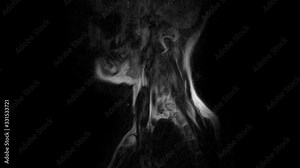 MRI of the cervical spine, detection of protrusions and hernias
