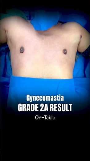 Gynecomastia Grade 2A Result #gynecomastia #gyno #transformation