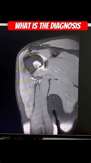 Mri shoulder #radiotechno07 #medicaltest #subscribe #shortvideo